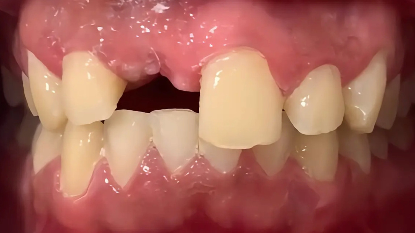 Smile Makeover — patient smile before treatment