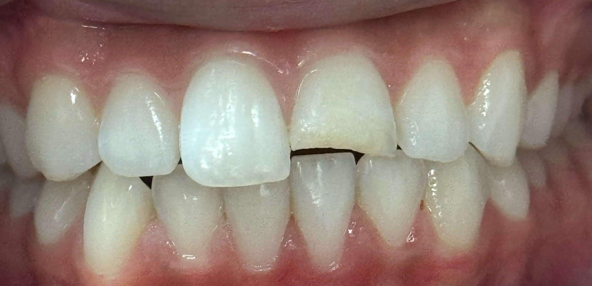 Cosmetic Bonding — patient smile before treatment
