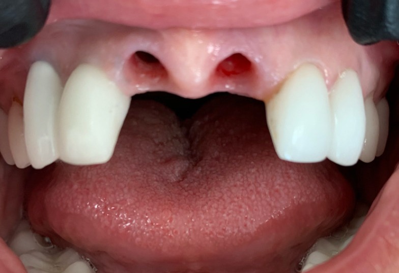 Dental Implants — patient smile before treatment