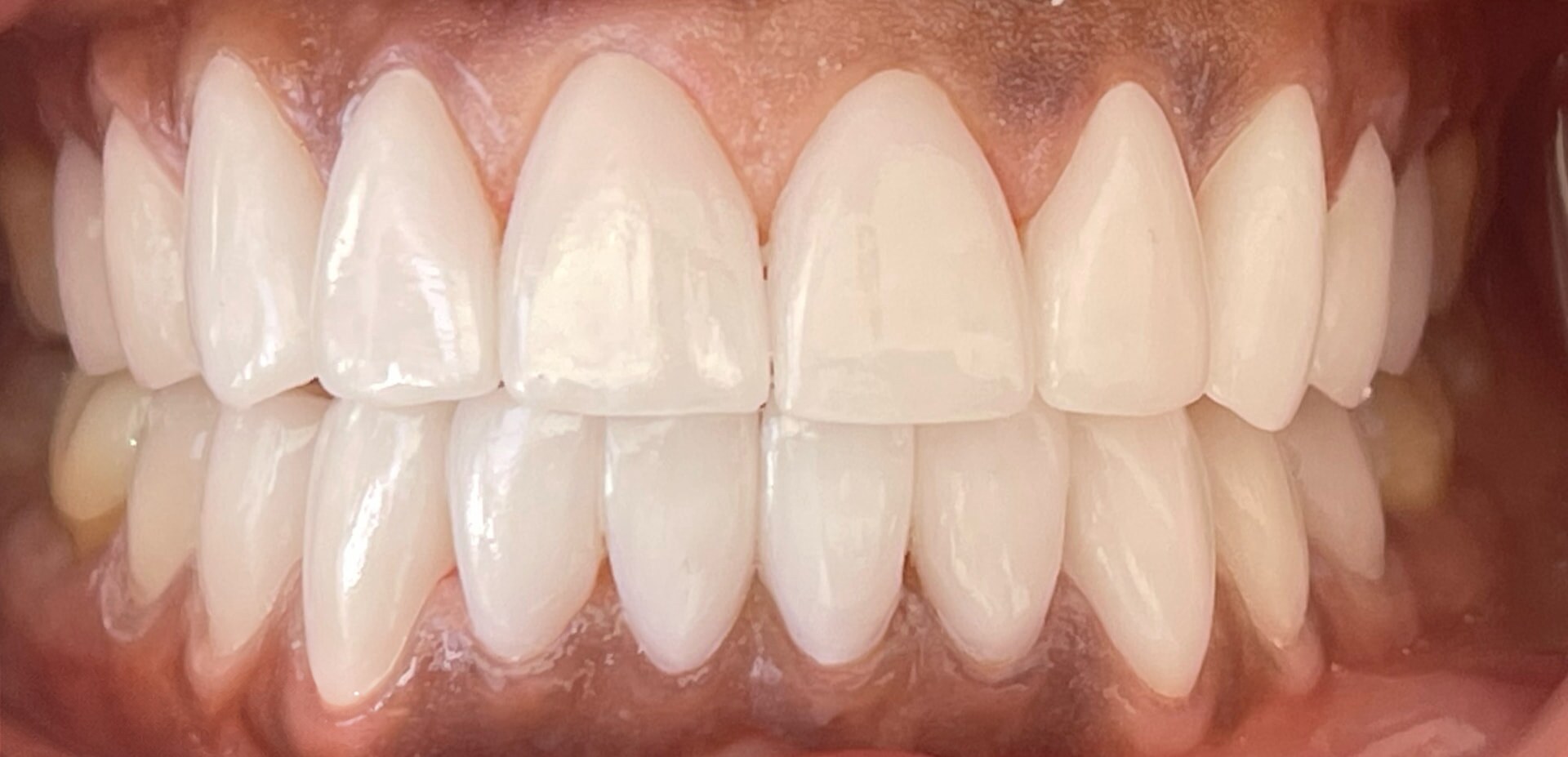 Porcelain Veneers — patient smile after treatment