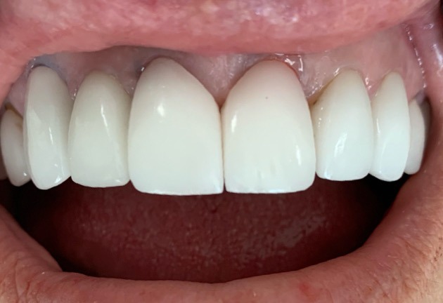 Dental Implants — patient smile after treatment