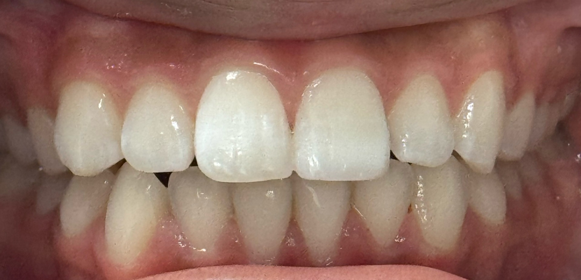 Cosmetic Bonding — patient smile after treatment
