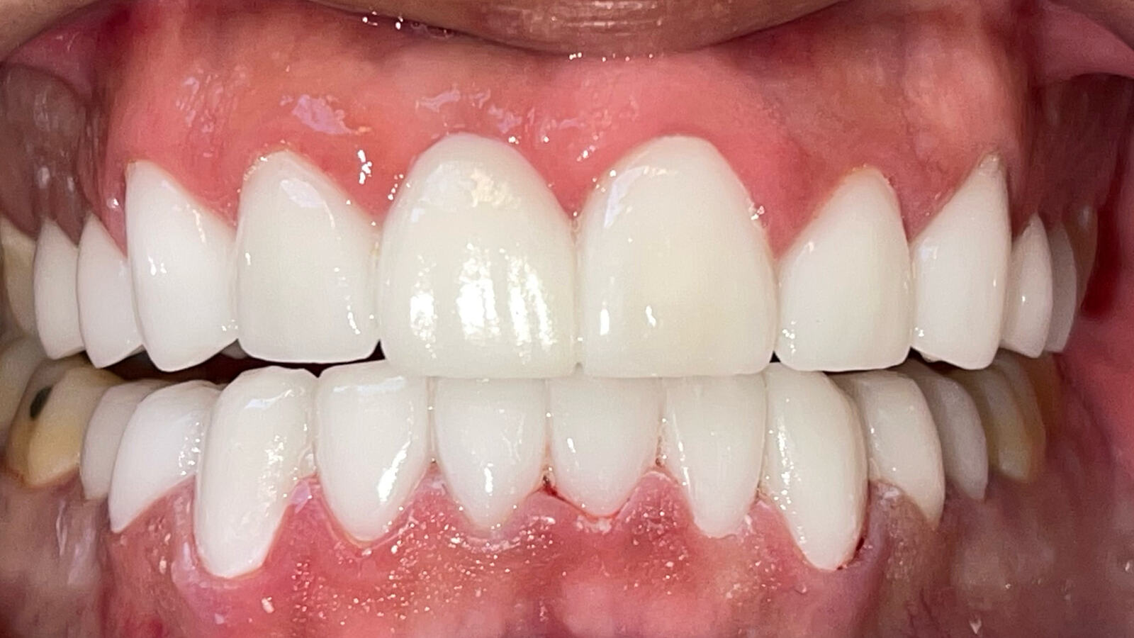 Smile Makeover — patient smile after treatment
