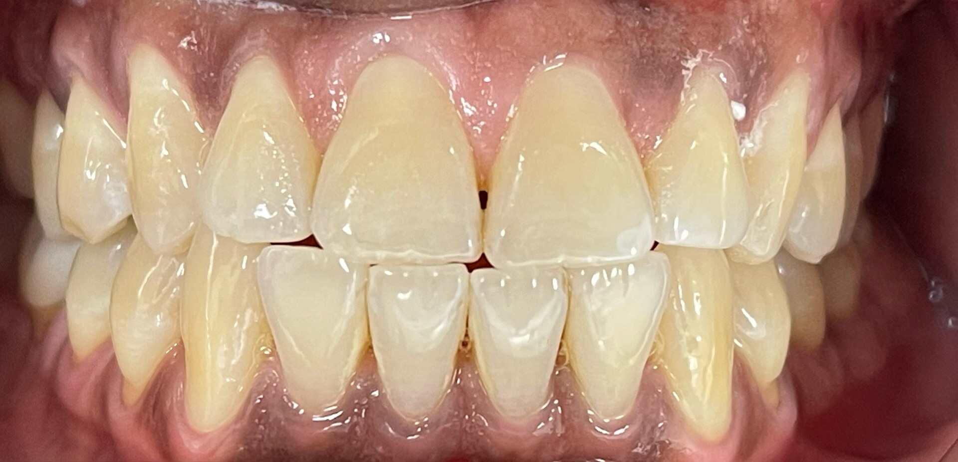 Porcelain Veneers — patient smile before treatment